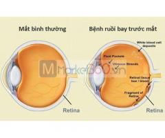 Bệnh Vẩn Đục Dịch Kính|Bệnh Viện Mắt BMT