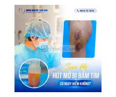 Tại sao sau hút mỡ bị bầm tím?